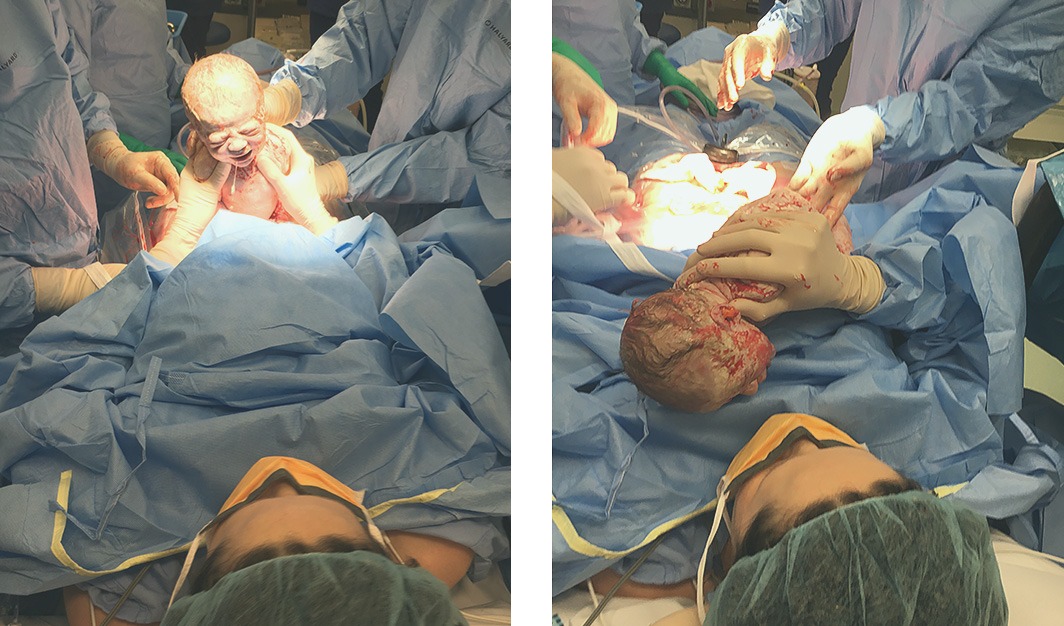 Maternal Assisted Caesarean with Melbourne Obstetrician 