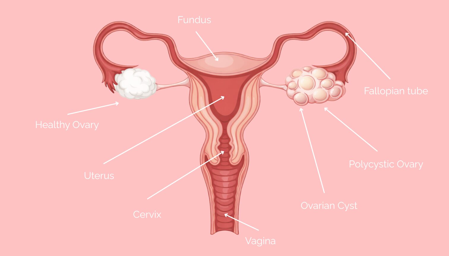 PCOS Diagram