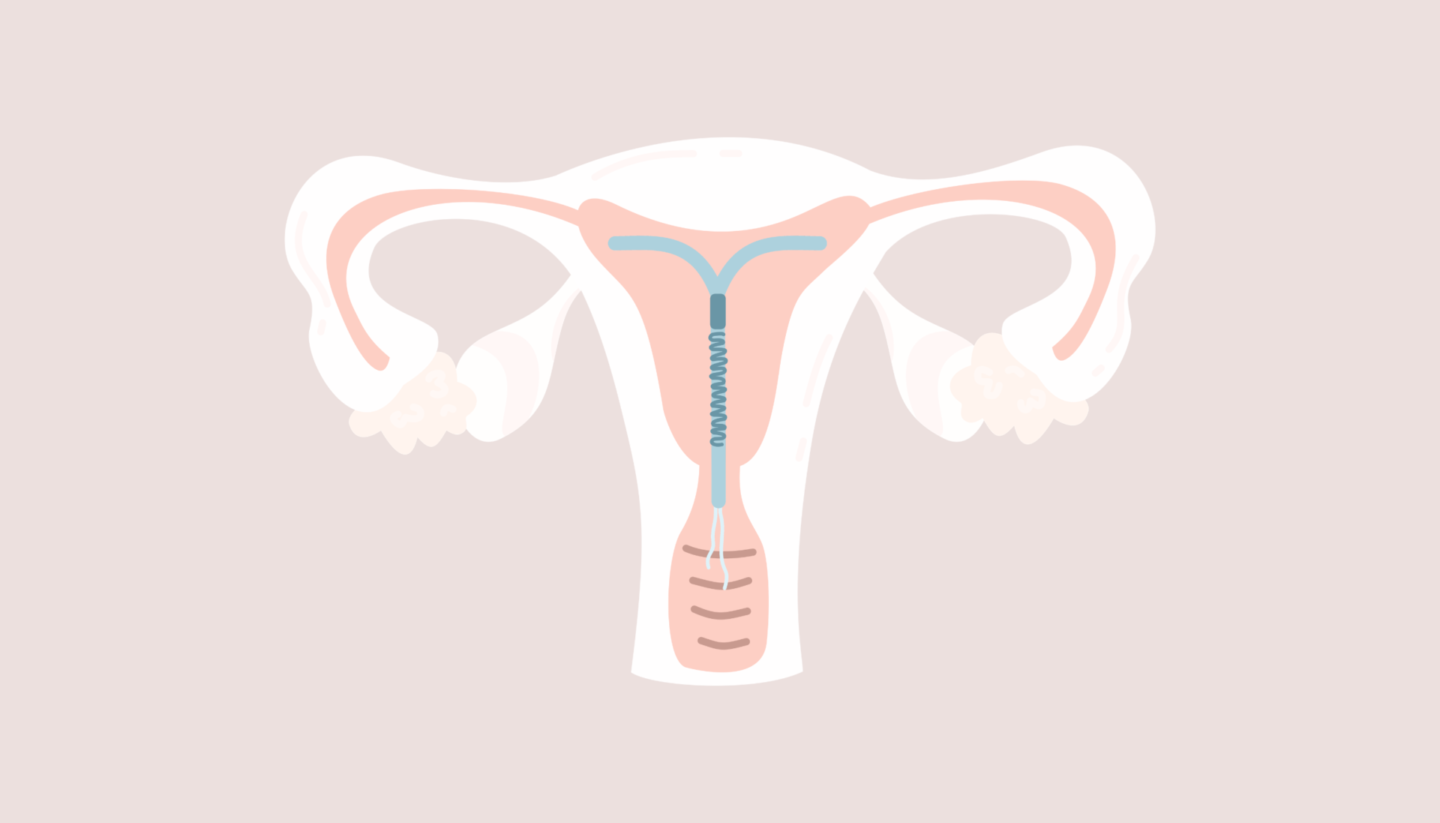 IUD Insertion Melbourne